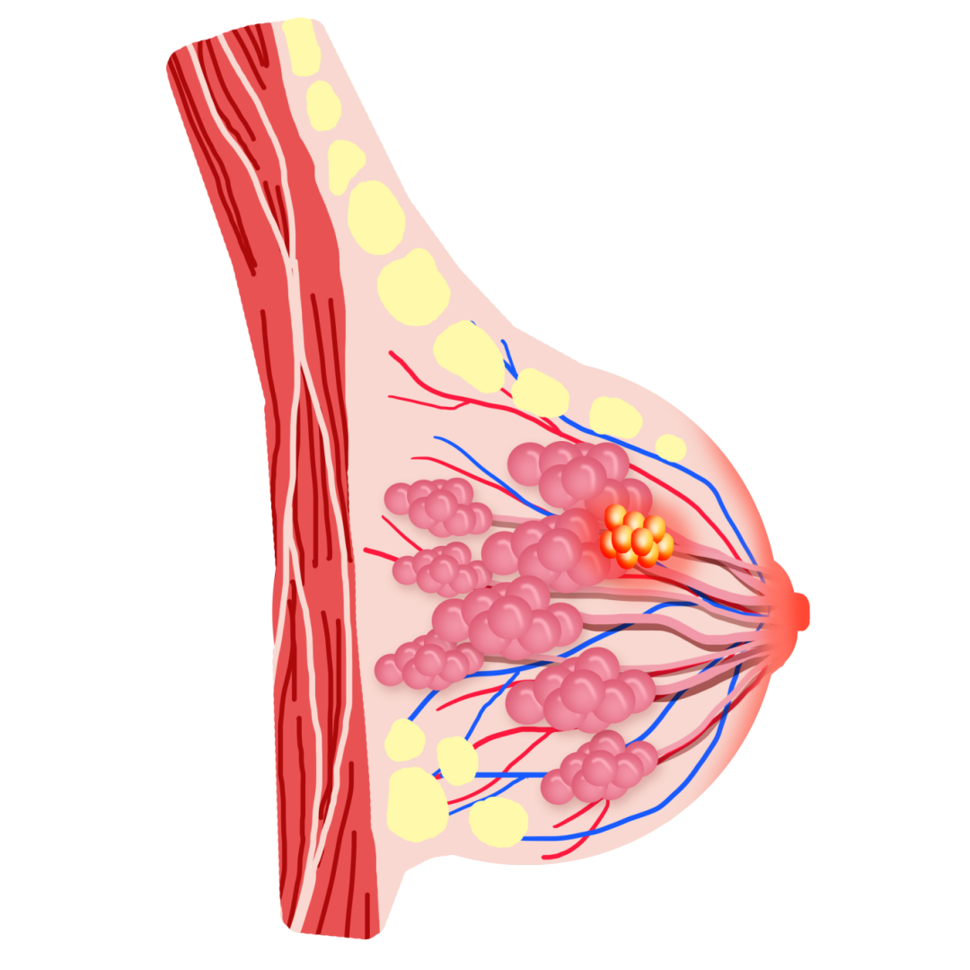 包圖網_19657413乳房腫瘤乳腺癌乳腺疾病.png